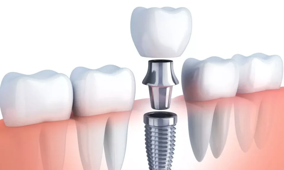 Dental Implant