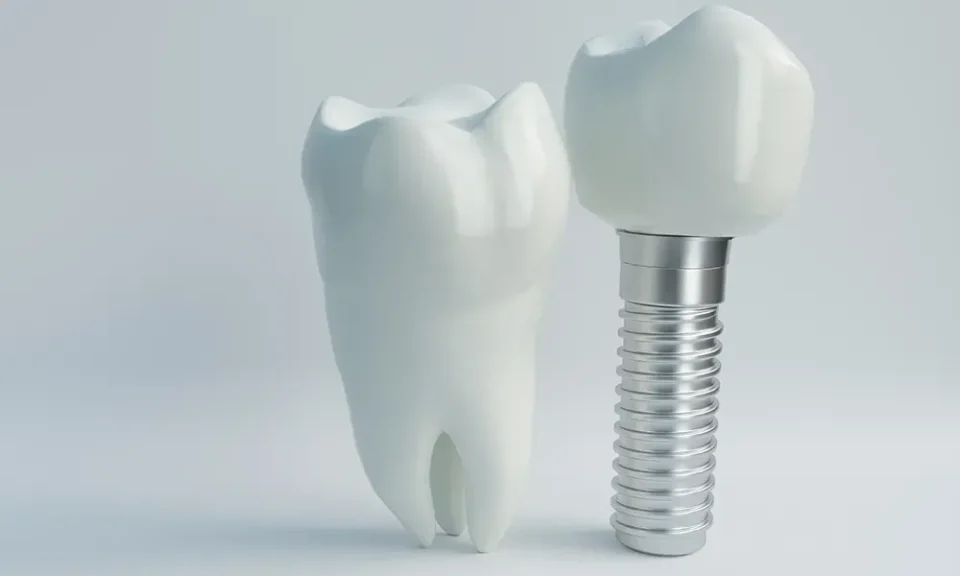 Dental Implants