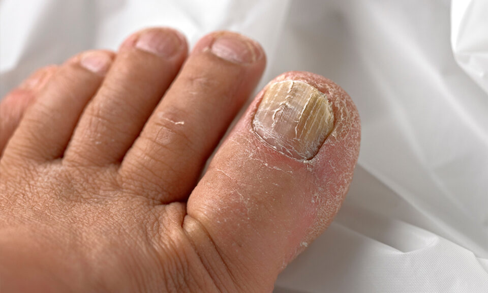 Fungal Nail Infections