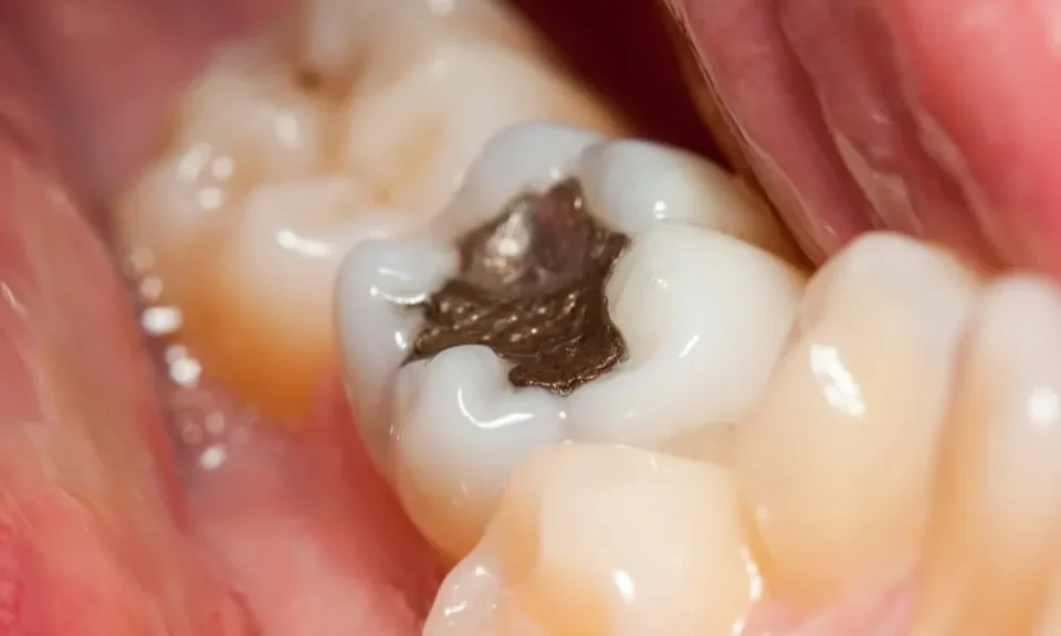 Dental Filling