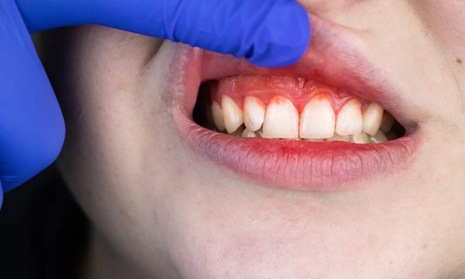 Periodontal Disease